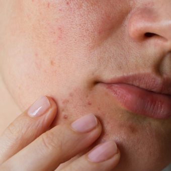 perioral dermatitis