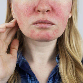 rosacea