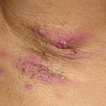 Hidradenitis Suppurativa