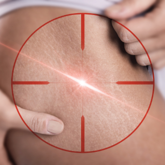 Skin Deep Magazine - The Fight Against Cellulite. Picture of an orange with a measuring tape wrapped around it.