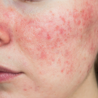 Woman with rosacea