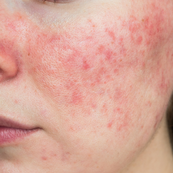Rosacea skin