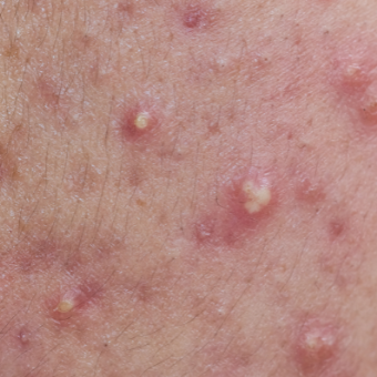 pustules and blackheads