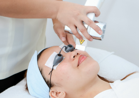 Client receives IPL for acne