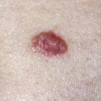 Basal Cell Carcinoma